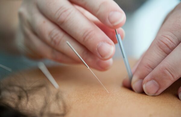 Acupuncture treatment